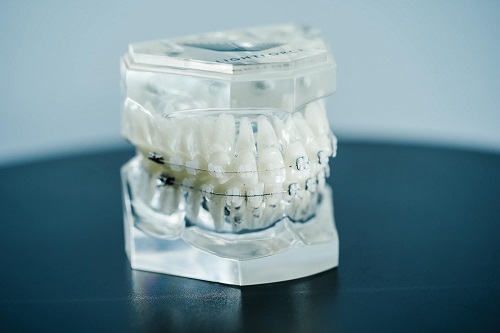 LightForce Braces