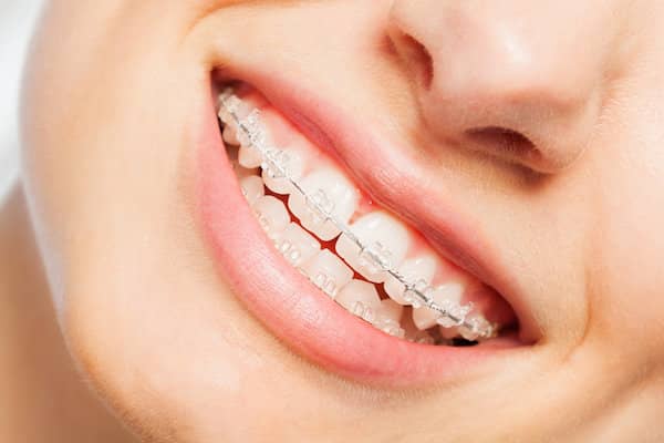 Young woman with clear ceramic braces